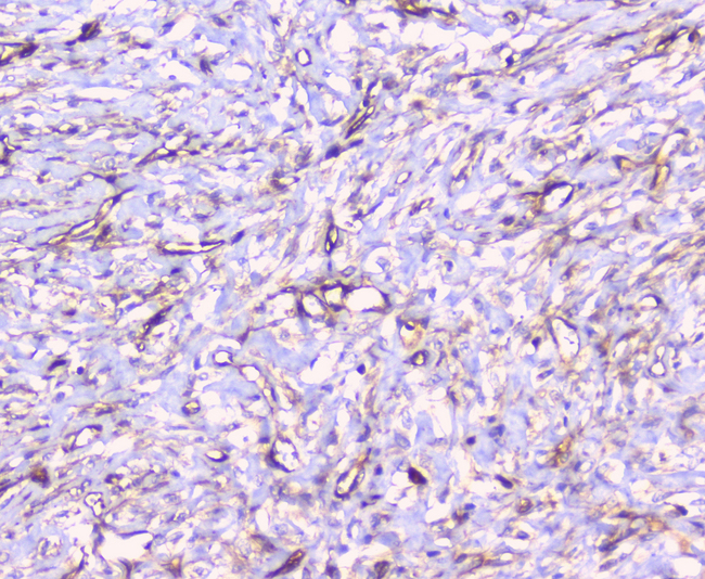 CD32A Antibody - IHC analysis of FCGR2A using anti-FCGR2A antibody. FCGR2A was detected in paraffin-embedded section of human mammary cancer tissue. Heat mediated antigen retrieval was performed in citrate buffer (pH6, epitope retrieval solution) for 20 mins. The tissue section was blocked with 10% goat serum. The tissue section was then incubated with 1µg/ml rabbit anti-FCGR2A Antibody overnight at 4°C. Biotinylated goat anti-rabbit IgG was used as secondary antibody and incubated for 30 minutes at 37°C. The tissue section was developed using Strepavidin-Biotin-Complex (SABC) with DAB as the chromogen.