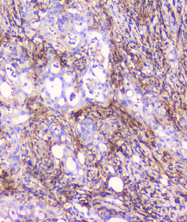CD32A Antibody - IHC analysis of FCGR2A using anti-FCGR2A antibody. FCGR2A was detected in paraffin-embedded section of human rectal cancer tissue. Heat mediated antigen retrieval was performed in citrate buffer (pH6, epitope retrieval solution) for 20 mins. The tissue section was blocked with 10% goat serum. The tissue section was then incubated with 1µg/ml rabbit anti-FCGR2A Antibody overnight at 4°C. Biotinylated goat anti-rabbit IgG was used as secondary antibody and incubated for 30 minutes at 37°C. The tissue section was developed using Strepavidin-Biotin-Complex (SABC) with DAB as the chromogen.