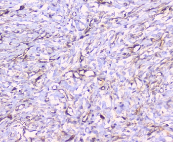 CD32A Antibody - IHC staining of FFPE human breast cancer with CD32 antibody at 1ug/ml. HIER: boil tissue sections in pH6, 10mM citrate buffer, for 10-20 min followed by cooling at RT for 20 min.