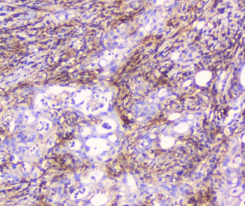 CD32A Antibody - IHC staining of FFPE human rectal cancer with CD32 antibody at 1ug/ml. HIER: boil tissue sections in pH6, 10mM citrate buffer, for 10-20 min followed by cooling at RT for 20 min.