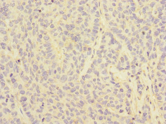 CD32C Antibody - Immunohistochemistry of paraffin-embedded human ovarian cancer at dilution 1:100