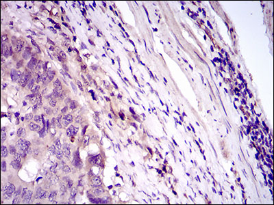 CD33 Antibody - IHC of paraffin-embedded esophageal cancer tissues using CD33 mouse monoclonal antibody with DAB staining.