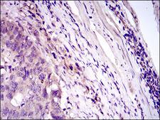 CD33 Antibody - IHC of paraffin-embedded esophageal cancer tissues using CD33 mouse monoclonal antibody with DAB staining.