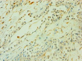 CD33 Antibody - Immunohistochemistry of paraffin-embedded human breast cancer using antibody at 1:100 dilution.