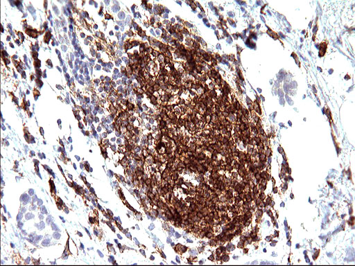 CD33 Antibody - IHC of paraffin-embedded Adenocarcinoma of Human breast tissue using anti-CD33 mouse monoclonal antibody. (Heat-induced epitope retrieval by 10mM citric buffer, pH6.0, 120°C for 3min).