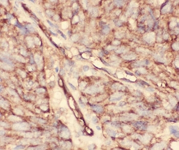 CD34 Antibody - IHC-P: CD34 antibody testing of human lung cancer tissue