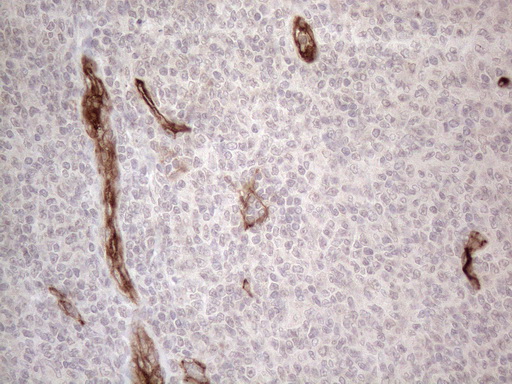 CD34 Antibody - Immunohistochemical staining of paraffin-embedded Human lymphoma tissue using anti-CD34 mouse monoclonal antibody. (Heat-induced epitope retrieval by 1mM EDTA in 10mM Tris buffer. (pH8.5) at 120°C for 3 min. (1:150)