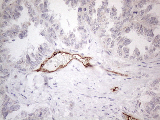 CD34 Antibody - Immunohistochemical staining of paraffin-embedded Adenocarcinoma of Human ovary tissue using anti-CD34 mouse monoclonal antibody. (Heat-induced epitope retrieval by 1mM EDTA in 10mM Tris buffer. (pH8.5) at 120°C for 3 min. (1:150)