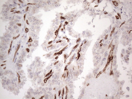 CD34 Antibody - Immunohistochemical staining of paraffin-embedded Carcinoma of Human thyroid tissue using anti-CD34 mouse monoclonal antibody. (Heat-induced epitope retrieval by 1mM EDTA in 10mM Tris buffer. (pH8.5) at 120°C for 3 min. (1:150)