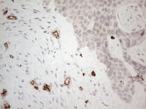CD34 Antibody - Immunohistochemical staining of paraffin-embedded Adenocarcinoma of Human endometrium tissue using anti-CD34 mouse monoclonal antibody. (Heat-induced epitope retrieval by 1mM EDTA in 10mM Tris buffer. (pH8.5) at 120°C for 3 min. (1:150)