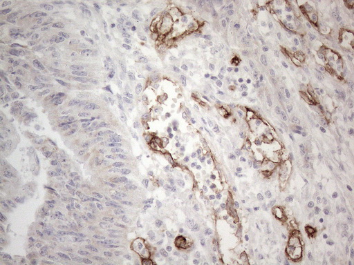 CD34 Antibody - Immunohistochemical staining of paraffin-embedded Adenocarcinoma of Human colon tissue using anti-CD34 mouse monoclonal antibody. (Heat-induced epitope retrieval by 1mM EDTA in 10mM Tris buffer. (pH8.5) at 120°C for 3 min. (1:150)