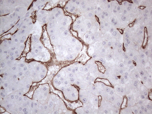 CD34 Antibody - Immunohistochemical staining of paraffin-embedded Carcinoma of Human liver tissue using anti-CD34 mouse monoclonal antibody. (Heat-induced epitope retrieval by 1mM EDTA in 10mM Tris buffer. (pH8.5) at 120°C for 3 min. (1:150)