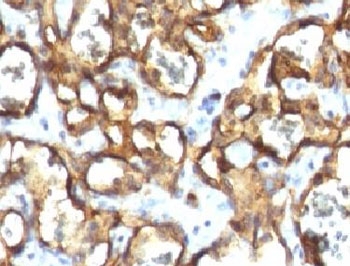 CD34 Antibody - IHC testing of FFPE human angiosarcoma with CD34 antibody (clone CDLA34-1).  This image was taken for the unmodified form of this product. Other forms have not been tested.