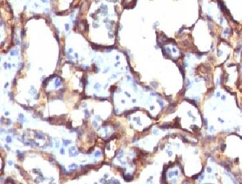 CD34 Antibody - Formalin-fixed, paraffin-embedded human angiosarcoma stained with anti-CD34 antibody (HPCA1/1171).  This image was taken for the unmodified form of this product. Other forms have not been tested.