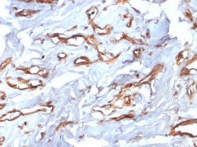 CD34 Antibody - Formalin-fixed, paraffin-embedded human Angiosarcoma stained with CD34 Recombinant Rabbit Monoclonal Antibody (HPCA1/2598R).