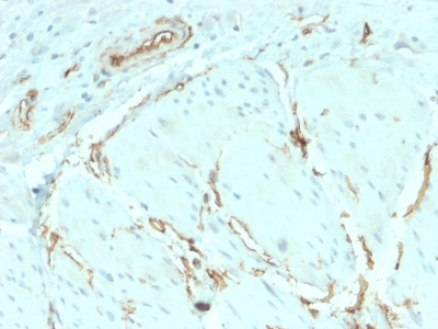 CD34 Antibody - Formalin-fixed, paraffin-embedded human Breast Carcinoma stained with CD34 Recombinant Rabbit Monoclonal Antibody (HPCA1/2598R).