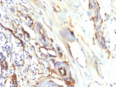 CD34 Antibody - Formalin-fixed, paraffin-embedded human Colon Carcinoma stained with CD34 Recombinant Rabbit Monoclonal Antibody (HPCA1/2598R).