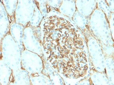 CD34 Antibody - Formalin-fixed, paraffin-embedded human Renal Cell Carcinoma stained with CD34 Recombinant Rabbit Monoclonal Antibody (HPCA1/2598R).