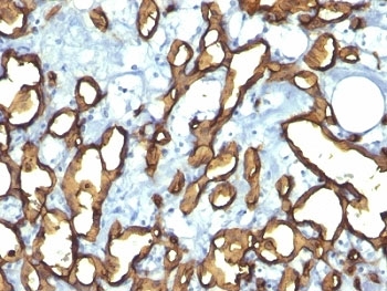 CD34 Antibody - Formalin-fixed, paraffin-embedded human angiosarcoma stained with CD34 antibody (HPCA1/763).  This image was taken for the unmodified form of this product. Other forms have not been tested.