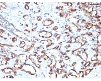 CD34 Antibody - Formalin-fixed, paraffin-embedded human angiosarcoma stained with CD34 antibody (SPM610).  This image was taken for the unmodified form of this product. Other forms have not been tested.