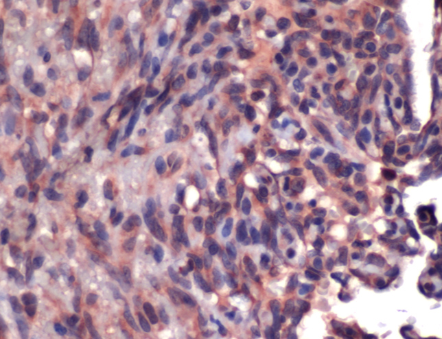 CD34 Antibody - Immunohistochemistry of Human Angiosarcoma stained with anti-CD34 (Endothelial Cell Marker) antibody