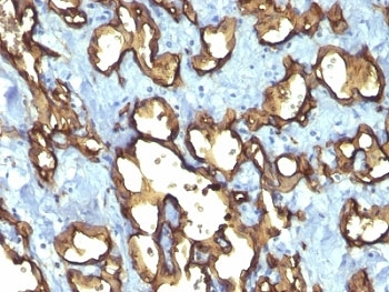 CD34 Antibody - Formalin-fixed, paraffin-embedded human angiosarcoma stained with CD34 antibody (QBEnd/10 + HPCA1/763).  This image was taken for the unmodified form of this product. Other forms have not been tested.