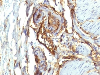 CD34 Antibody - Formalin-fixed, paraffin-embedded human colon carcinoma stained with CD34 antibody (QBEnd/10 + HPCA1/763).  This image was taken for the unmodified form of this product. Other forms have not been tested.