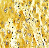 CD36 Antibody - Formalin-fixed and paraffin-embedded human hepatocarcinoma with CD36 Antibody , which was peroxidase-conjugated to the secondary antibody, followed by DAB staining. This data demonstrates the use of this antibody for immunohistochemistry; clinical relevance has not been evaluated.