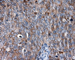 CD36 Antibody - Immunohistochemical staining of paraffin-embedded Adenocarcinoma of ovary tissue using anti-CD36 mouse monoclonal antibody. (Dilution 1:50).