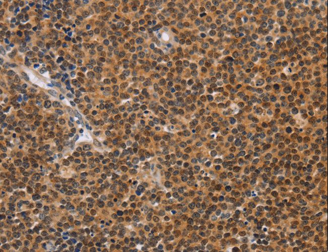 CD36 Antibody - Immunohistochemistry of paraffin-embedded Human thyroid cancer using CD36 Polyclonal Antibody at dilution of 1:60.