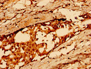 CD36 Antibody - Immunohistochemistry image of paraffin-embedded human breast cancer at a dilution of 1:100