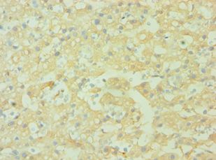 CD38 Antibody - Immunohistochemistry of paraffin-embedded human liver cancer using antibody at 1:100 dilution.