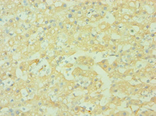 CD38 Antibody - Immunohistochemistry of paraffin-embedded human liver cancer using CD38 Antibody at dilution of 1:100