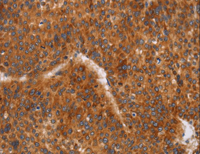 CD38 Antibody - Immunohistochemistry of paraffin-embedded Human liver cancer using CD38 Polyclonal Antibody at dilution of 1:60.