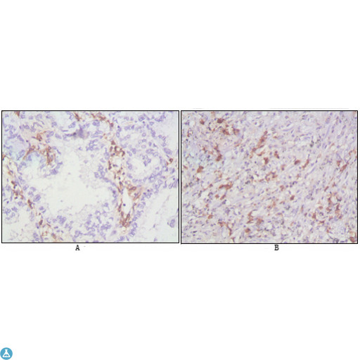 CD38 Antibody - Immunohistochemistry (IHC) analysis of paraffin-embedded human lung cancer (A), lymphonodus tissue (B), showing cytomembrane localization with DAB staining using CD38 Monoclonal Antibody.