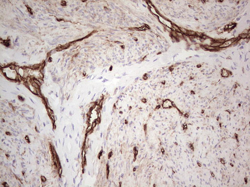 CD39 Antibody - Immunohistochemical staining of paraffin-embedded Adenocarcinoma of Human endometrium tissue using anti-ENTPD1 mouse monoclonal antibody. (Heat-induced epitope retrieval by 1 mM EDTA in 10mM Tris, pH8.5, 120C for 3min,