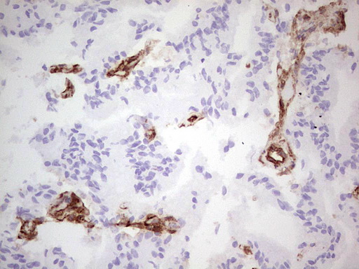 CD39 Antibody - Immunohistochemical staining of paraffin-embedded Carcinoma of Human prostate tissue using anti-ENTPD1 mouse monoclonal antibody. (Heat-induced epitope retrieval by 1 mM EDTA in 10mM Tris, pH8.5, 120C for 3min,