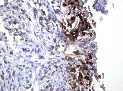CD3E Antibody - Immunohistochemical staining of paraffin-embedded Adenocarcinoma of Human endometrium tissue using anti-UM500048 mouse monoclonal antibody.  heat-induced epitope retrieval by 10mM citric buffer, pH6.0, 120C for 3min)