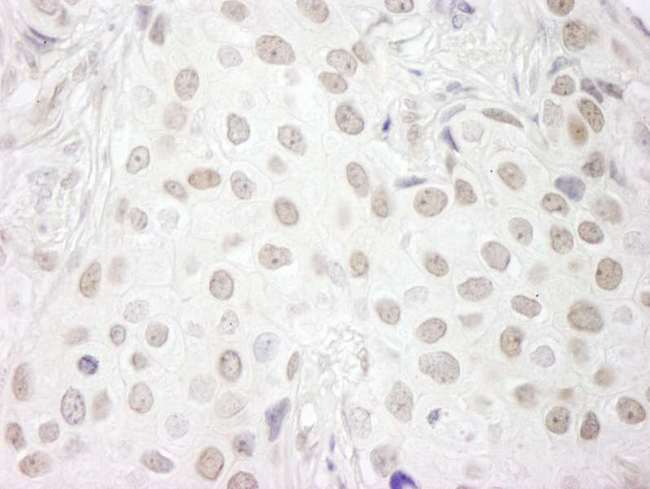 CD3EAP Antibody - Detection of Human PAF49/CAST by Immunohistochemistry. Sample: FFPE section of human breast carcinoma. Antibody: Affinity purified rabbit anti-PAF49/CAST used at a dilution of 1:1,250. Epitope Retrieval Buffer-High pH (IHC-101J) was substituted for Epitope Retrieval Buffer-Reduced pH.