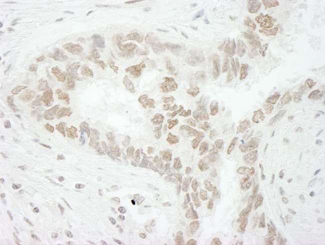 CD3EAP Antibody - Detection of Human PAF49/CAST by Immunohistochemistry. Sample: FFPE section of human lung carcinoma. Antibody: Affinity purified rabbit anti-PAF49/CAST used at a dilution of 1:1,250. Epitope Retrieval Buffer-High pH (IHC-101J) was substituted for Epitope Retrieval Buffer-Reduced pH.