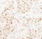 CD3EAP Antibody - Detection of Human PAF49/CAST by Immunohistochemistry. Sample: FFPE section of human breast carcinoma. Antibody: Affinity purified rabbit anti-PAF49/CAST used at a dilution of 1:200 (1 ug/ml). Detection: DAB.