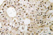 CD3EAP Antibody - IHC of CD3EAP (E474) pAb in paraffin-embedded human breast carcinoma tissue.