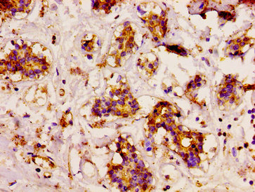 CD3EAP Antibody - Immunohistochemistry image at a dilution of 1:200 and staining in paraffin-embedded human breast cancer performed on a Leica BondTM system. After dewaxing and hydration, antigen retrieval was mediated by high pressure in a citrate buffer (pH 6.0) . Section was blocked with 10% normal goat serum 30min at RT. Then primary antibody (1% BSA) was incubated at 4 °C overnight. The primary is detected by a biotinylated secondary antibody and visualized using an HRP conjugated SP system.