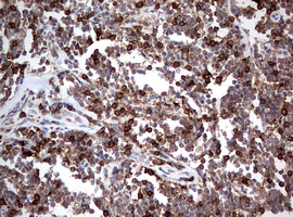 CD4 Antibody - IHC of paraffin-embedded Human lymphoma tissue using anti-CD4 mouse monoclonal antibody. (Heat-induced epitope retrieval by 10mM citric buffer, pH6.0, 120°C for 3min).