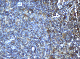 CD4 Antibody - IHC of paraffin-embedded Human lymphoma tissue using anti-CD4 mouse monoclonal antibody.