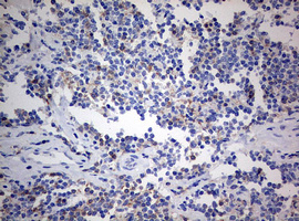 CD4 Antibody - IHC of paraffin-embedded Human lymphoma tissue using anti-CD4 mouse monoclonal antibody. (Heat-induced epitope retrieval by 10mM citric buffer, pH6.0, 120°C for 3min).