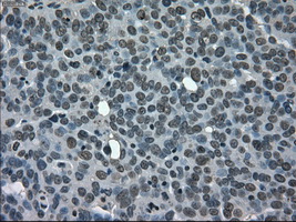 CD4 Antibody - IHC of paraffin-embedded Adenocarcinoma of ovary tissue using anti-CD4 mouse monoclonal antibody. (Dilution 1:50).