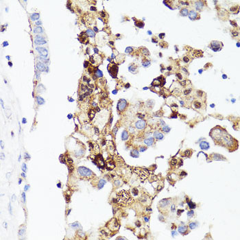 CD4 Antibody - Immunohistochemistry of paraffin-embedded human lung cancer using CD4 antibody at dilution of 1:150 (40x lens).