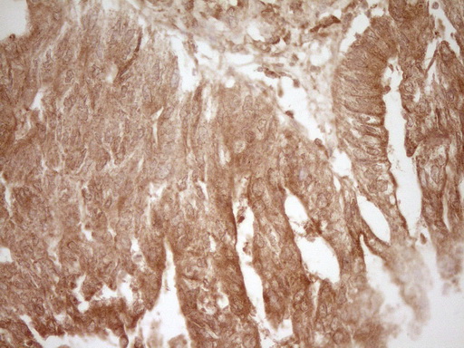 CD40 Antibody - IHC of paraffin-embedded Adenocarcinoma of Human colon tissue using anti-CD40 mouse monoclonal antibody. (Heat-induced epitope retrieval by 1 mM EDTA in 10mM Tris, pH8.5, 120°C for 3min).