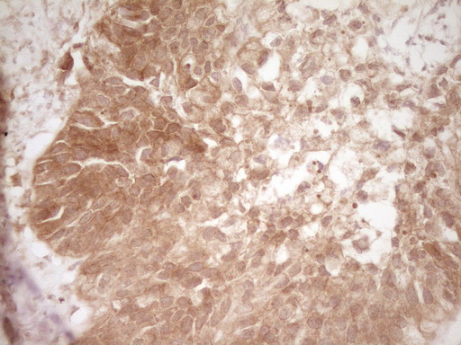 CD40 Antibody - IHC of paraffin-embedded Carcinoma of Human kidney tissue using anti-CD40 mouse monoclonal antibody. (Heat-induced epitope retrieval by 1 mM EDTA in 10mM Tris, pH8.5, 120°C for 3min).